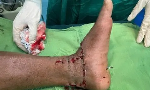 Lưỡi máy phát cỏ gãy, chém đứt lìa bàn chân người đàn ông