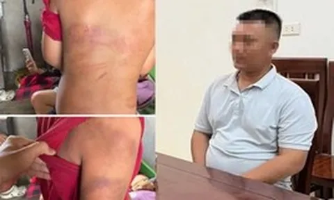 Vụ bé trai 10 tuổi người thâm tím nghi bị bạo hành: Lời khai của bố đẻ