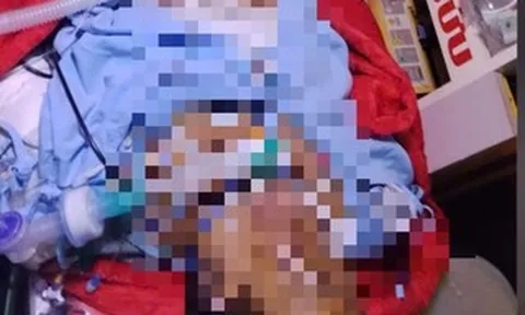 Bị bỏng nặng, mẹ đợi con thi xong tốt nghiệp THPT mới yên lòng nhắm mắt
